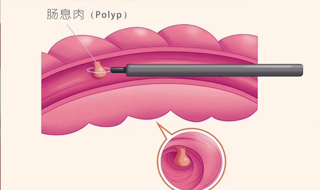 【健康科普】胃肠镜的八大谎言，您千万别信(图3)