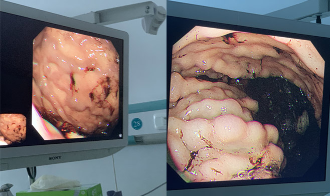 【健康科普】胃肠镜的八大谎言，您千万别信(图5)